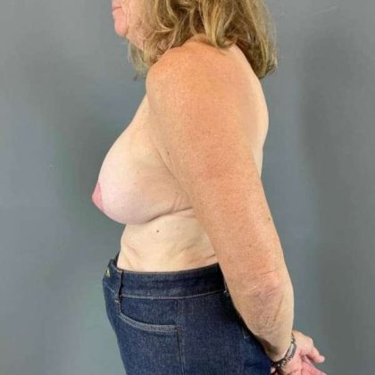 Breast Lift Before & After Patient #1073
