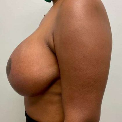 Breast Lift Before & After Patient #1084