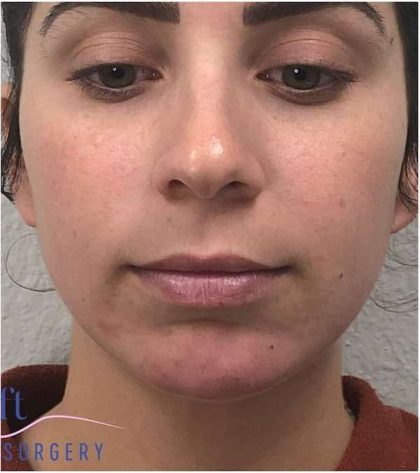 Injectables&Fillers Before & After Patient #125