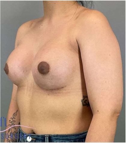 Breast Augmentation Before & After Patient #1219