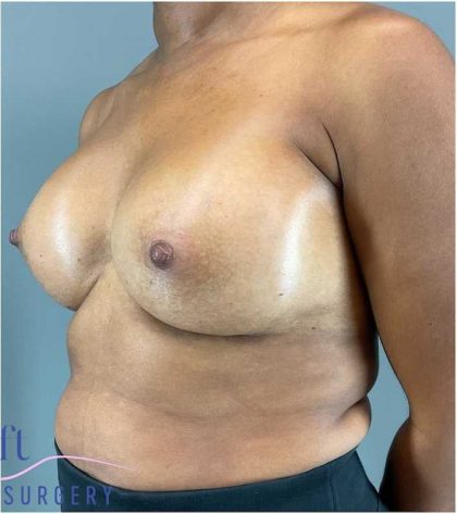 Breast Augmentation Before & After Patient #1307