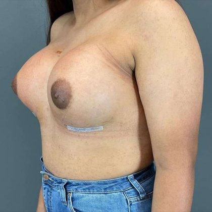 Breast Augmentation Before & After Patient #1318