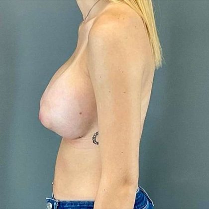 Breast Augmentation Before & After Patient #1340