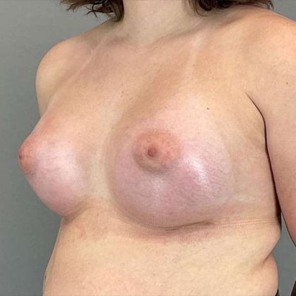 Breast Augmentation Before & After Patient #1362