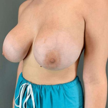 Breast Augmentation Before & After Patient #1384