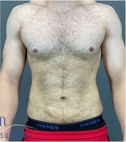Bodytite Before & After Patient #280
