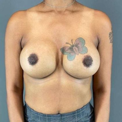 Breast Augmentation Before & After Patient #1428