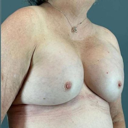 Breast Augmentation Before & After Patient #1450