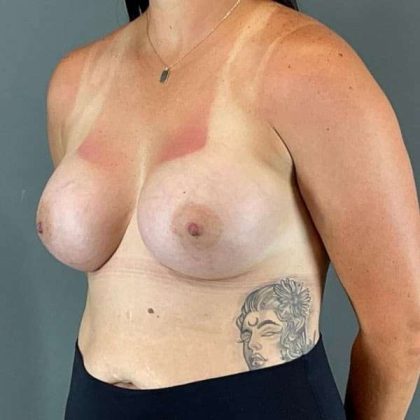 Breast Augmentation Before & After Patient #1472