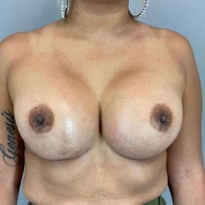 Breast Augmentation Before & After Patient #1483
