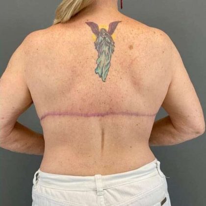 Back Lift Before & After Patient #287