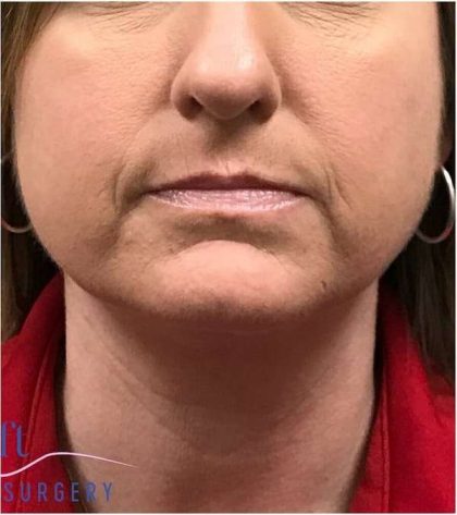 Necktite Before & After Patient #1624