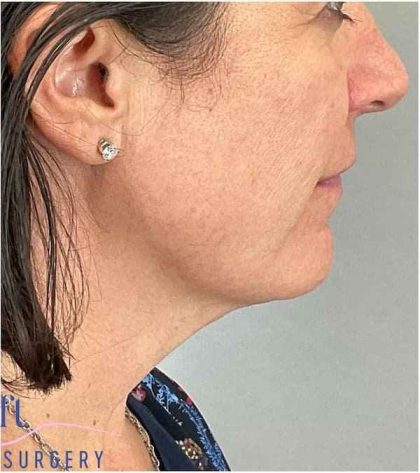 Necktite Before & After Patient #1633