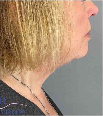 Neck Lift Before & After Patient #1649