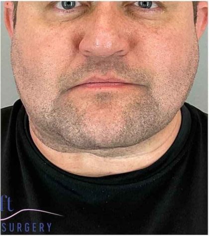 Neck Lift Before & After Patient #1660