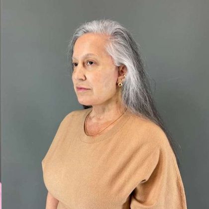 Neck Lift Before & After Patient #1671