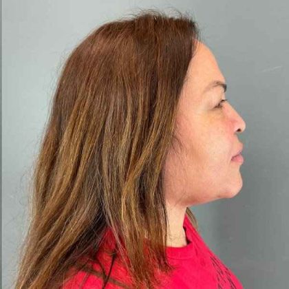 Neck Lift Before & After Patient #1678