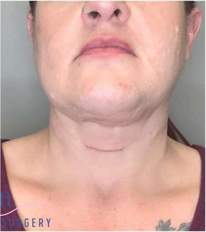 Neck Lift Before & After Patient #1696