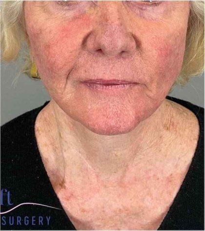 Facelift Before & After Patient #1703