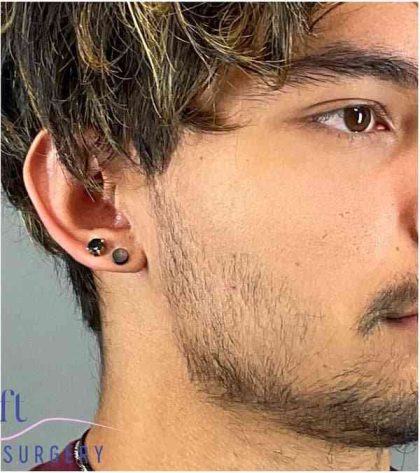 Ear Surgery Before & After Patient #1715