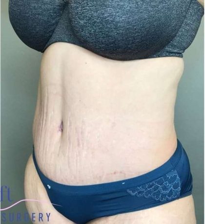 Tummy Tuck Before & After Patient #314