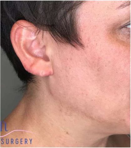 Ear Surgery Before & After Patient #1724