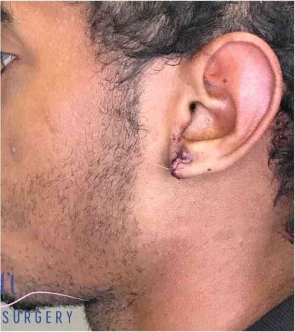 Ear Surgery Before & After Patient #1731