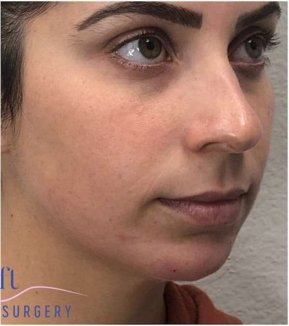 Chin Augmentation Before & After Patient #1738