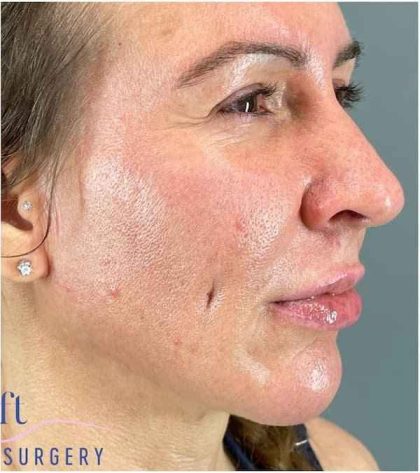 Chin Augmentation Before & After Patient #1747