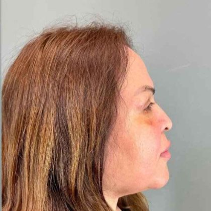 Eyelid Surgery Before & After Patient #1754