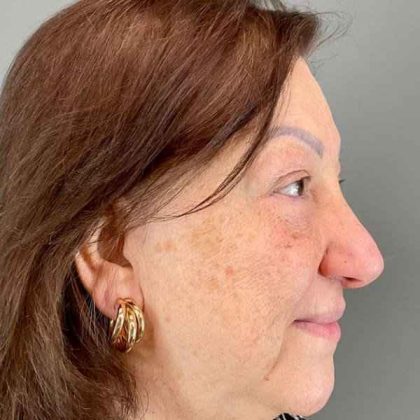 Eyelid Surgery Before & After Patient #1761