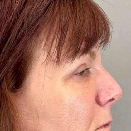 Eyelid Surgery Before & After Patient #1768