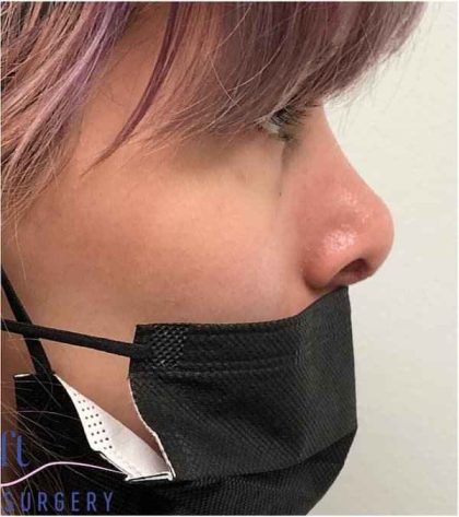Rhinoplasty Before & After Patient #1796