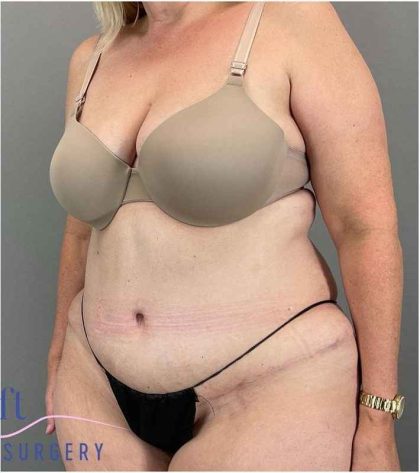 Tummy Tuck Before & After Patient #325