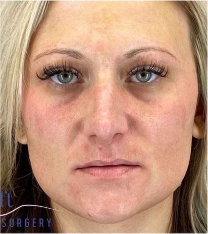 Rhinoplasty Before & After Patient #1807