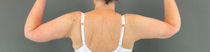 Arm Lift Before & After Patient #219