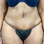 Tummy Tuck Before & After Patient #346