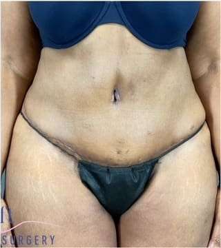 Tummy Tuck Before & After Patient #346