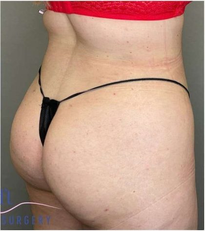 Liposuction Before & After Patient #166