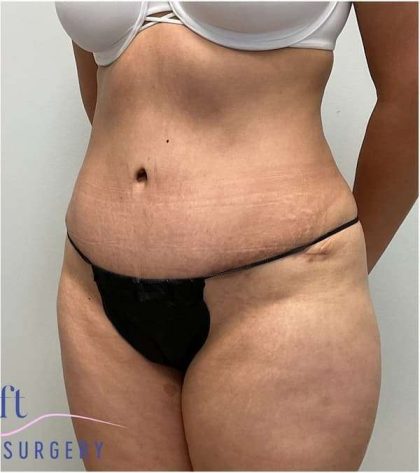Tummy Tuck Before & After Patient #357