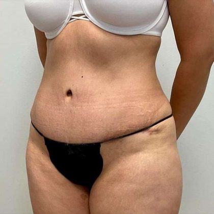 Tummy Tuck Before & After Patient #379