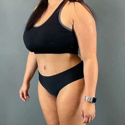 Tummy Tuck Before & After Patient #390