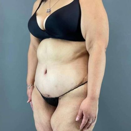 Tummy Tuck Before & After Patient #401