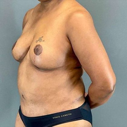 Tummy Tuck Before & After Patient #412