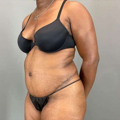 Tummy Tuck Before & After Patient #423