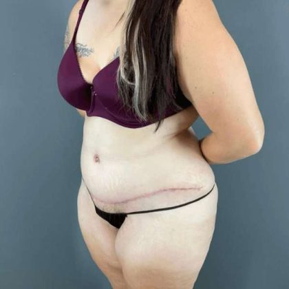 Tummy Tuck Before & After Patient #434
