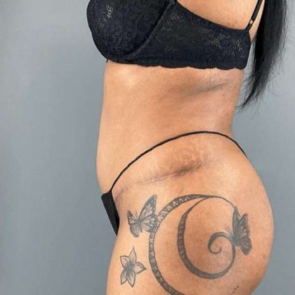 Tummy Tuck Before & After Patient #454