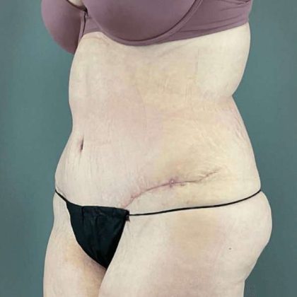 Tummy Tuck Before & After Patient #476