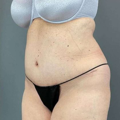 Tummy Tuck Before & After Patient #498