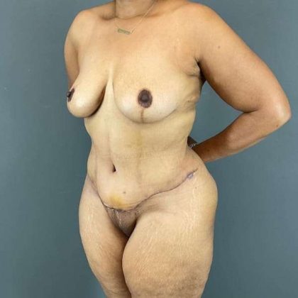 Tummy Tuck Before & After Patient #542